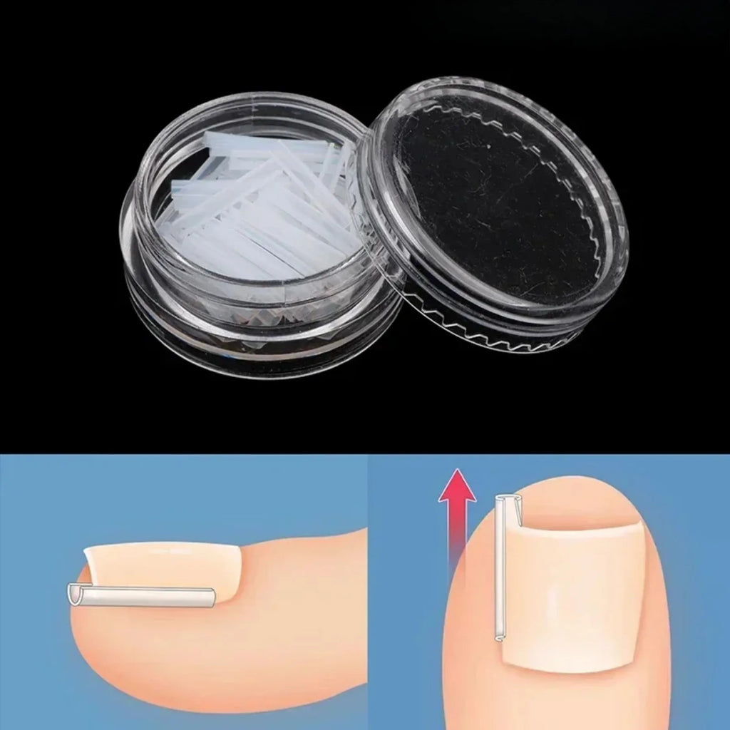 Kit de correction des ongles incarnés (50 pièces) : patch élastique, autocollant, clip redresseur et outil de pédicure