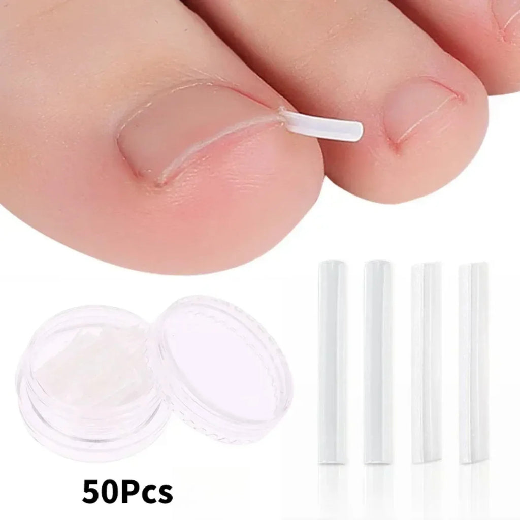 Kit de correction des ongles incarnés (50 pièces) : patch élastique, autocollant, clip redresseur et outil de pédicure