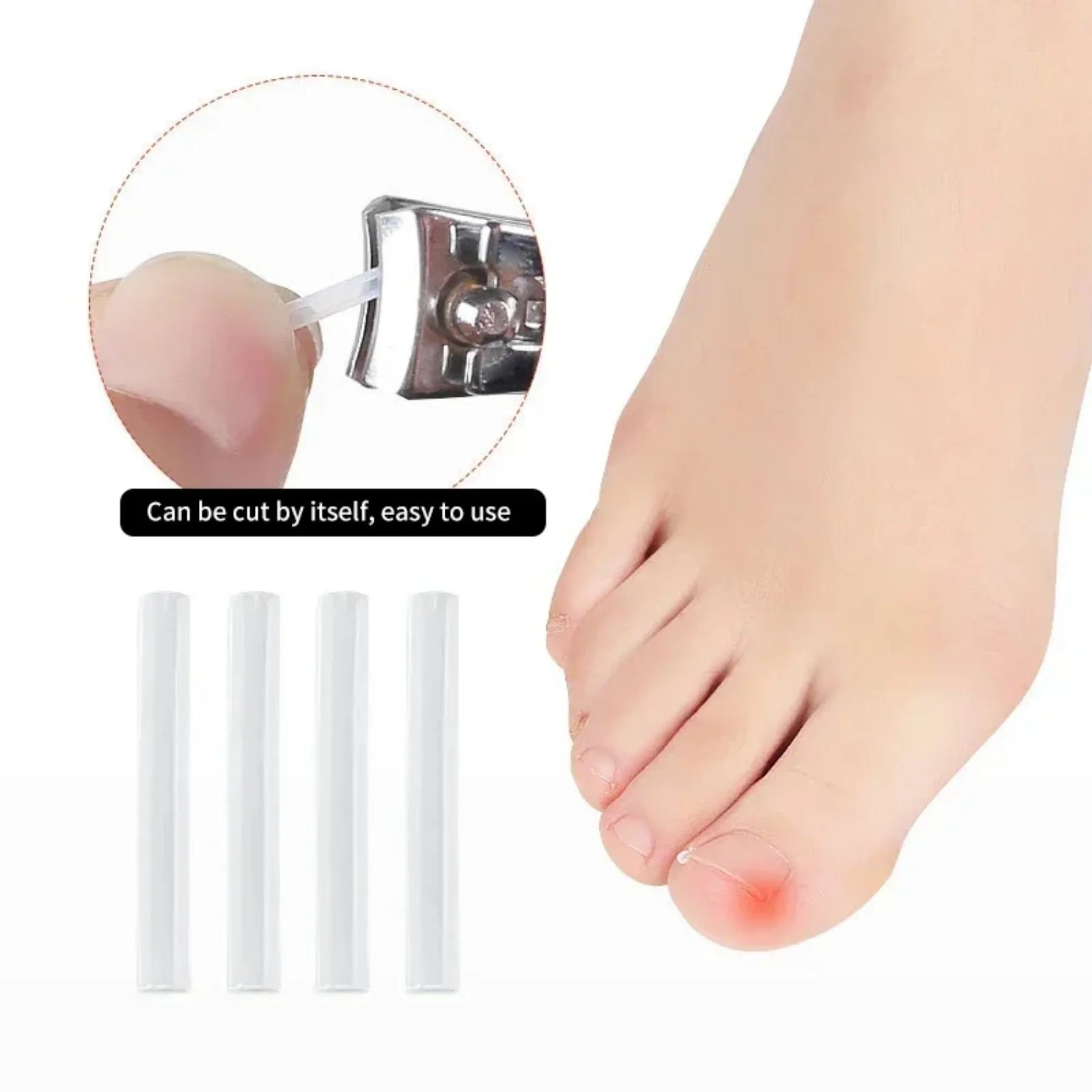 Kit de correction des ongles incarnés (50 pièces) : patch élastique, autocollant, clip redresseur et outil de pédicure